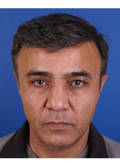 After Hair Transplant&nbsp;Front